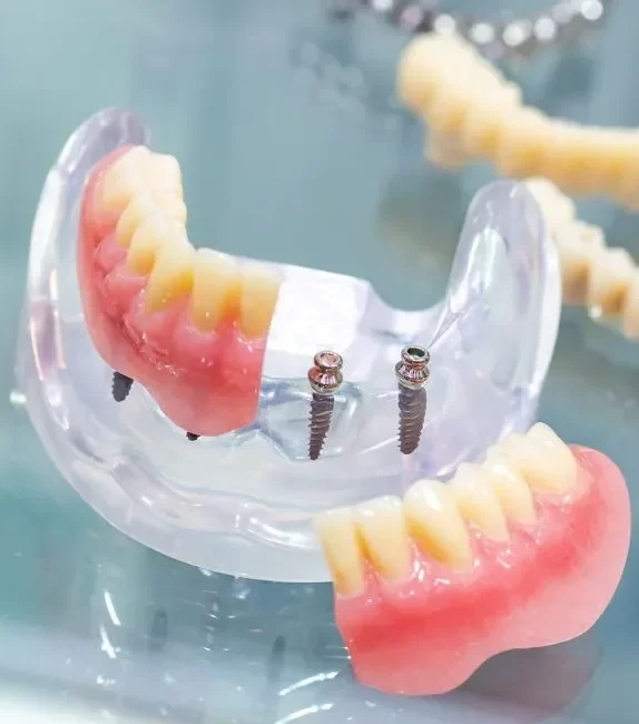 Full Arch Implants