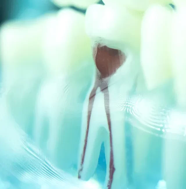 Root Canal